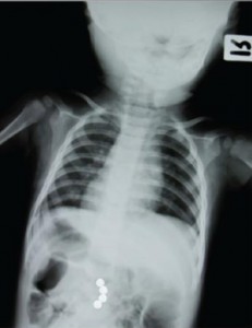 ingested magnet x-ray