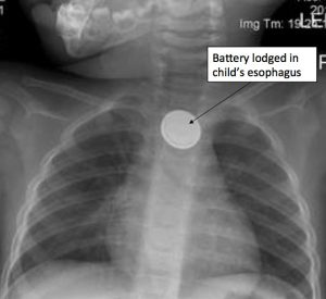 button battery x-ray