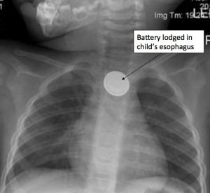 Button Battery Injury Attorneys in Oklahoma 2 Button Battery Injury Attorneys in Oklahoma