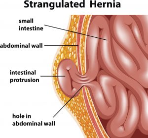 illustration of a strangulated hernia