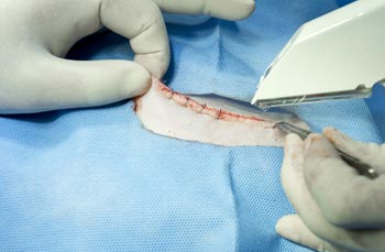 Defective Surgical Staplers Attorneys in Oklahoma