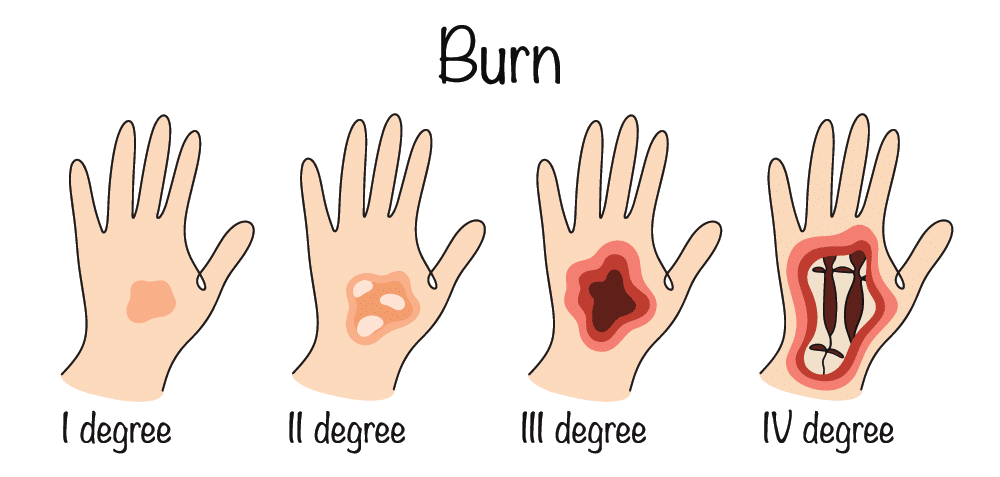 Oklahoma Burn Injury Attorneys 1 Burn Severity